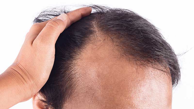 الصلع الوراثي وزراعة الشعر